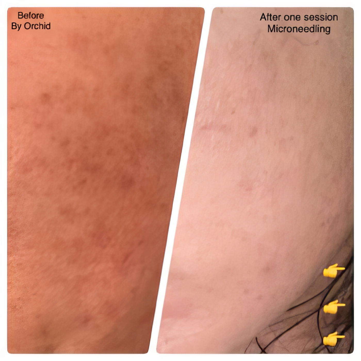 Before and After Image: Microneedling - front